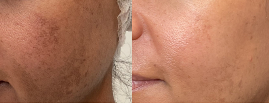 Before and after comparison of skin treatment on a person's face, showing improvement over 4 months.