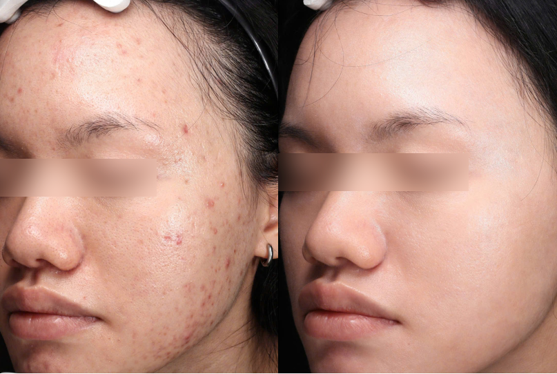 Ultraclear® Laser