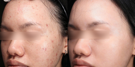 Ultraclear® Laser