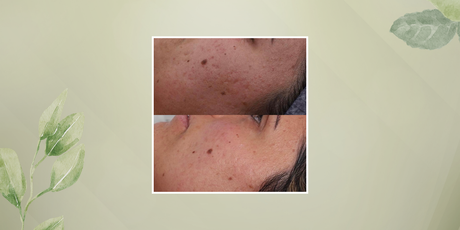 LEVEL 3 SKIN NEEDLING – Prepay 3 Get 4th Free