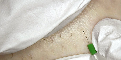 Electrolysis