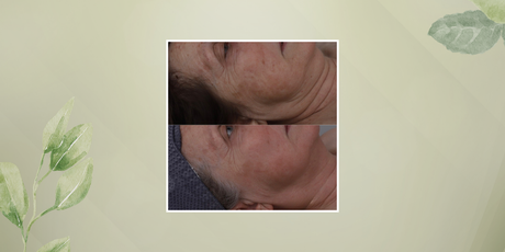 Ultraformer MPT Face & Neck Lift