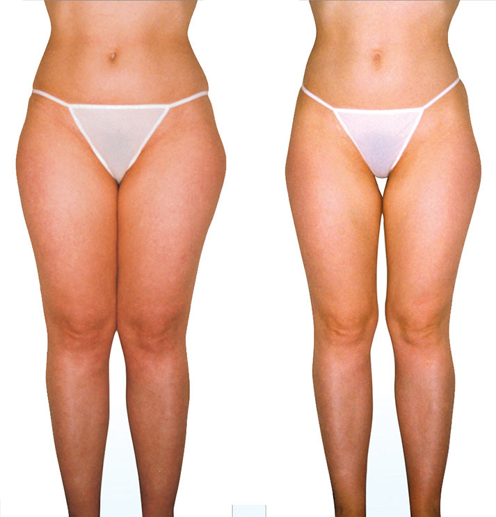 Endermologie