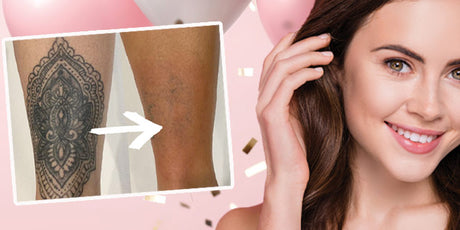 Tattoo Removal VIP Membership