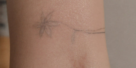One Year Tattoo Removal Membership
