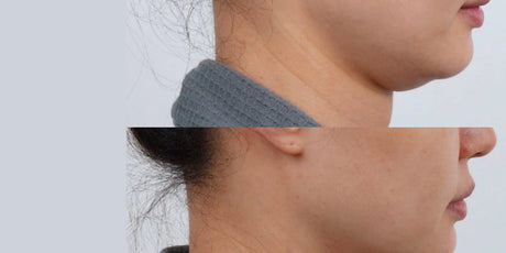 Jawline Definition