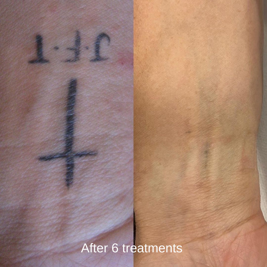 Pico laser tattoo removal