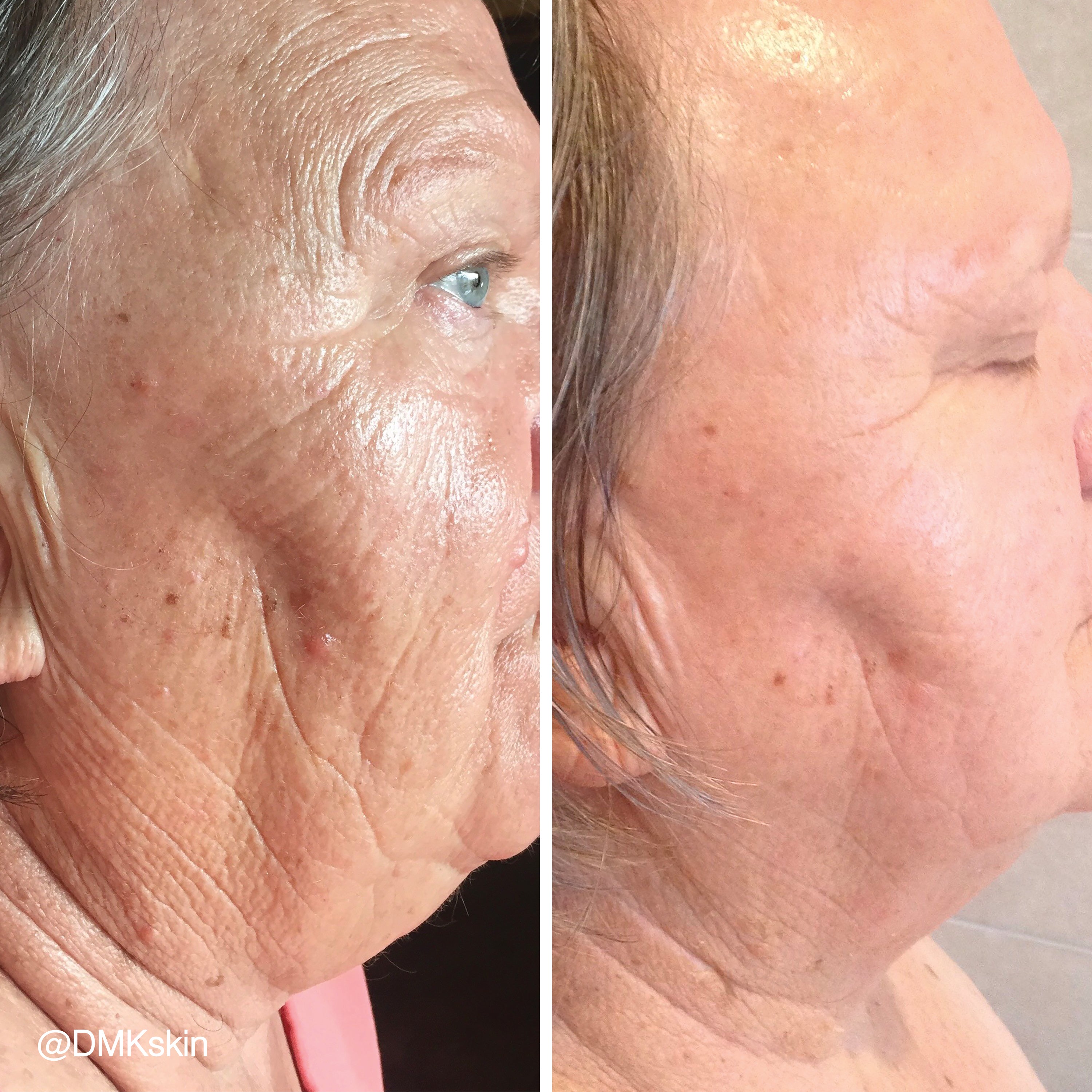 A-Lift Skin Fitness Program