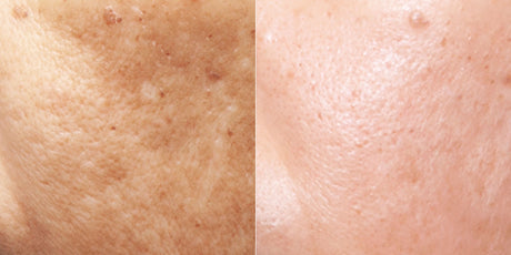 Cosmelan Pigmentation Treatment