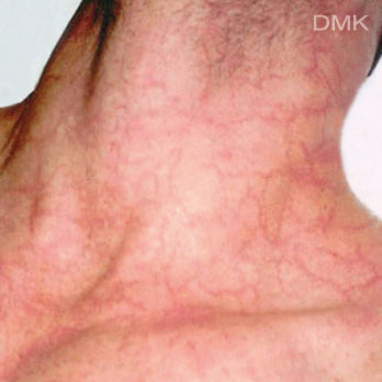 Enzyme Facial - Level 2