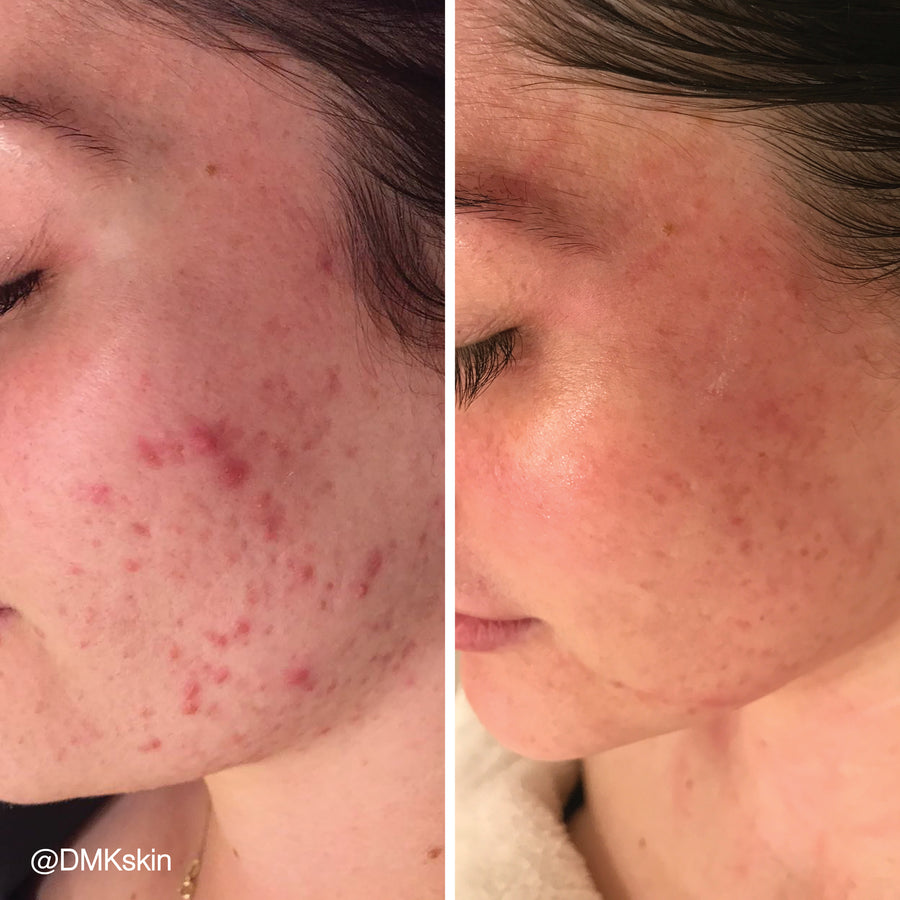 DMK Enzyme Facial - Level 2