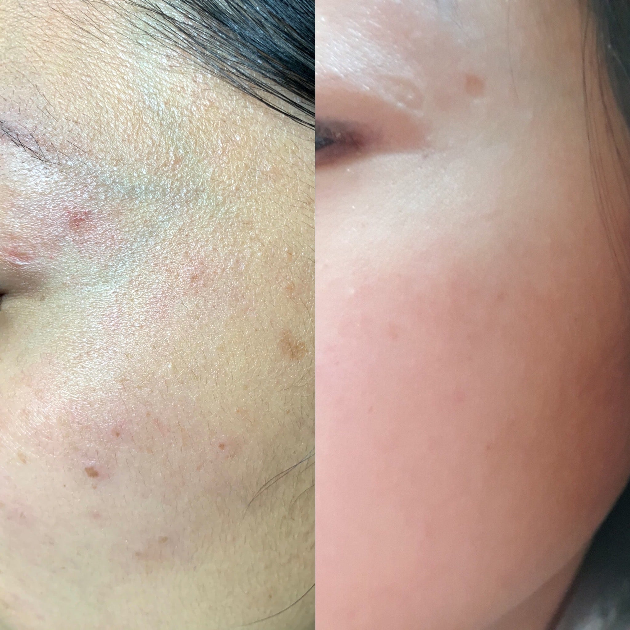 Pico Laser Skin Resurfacing
