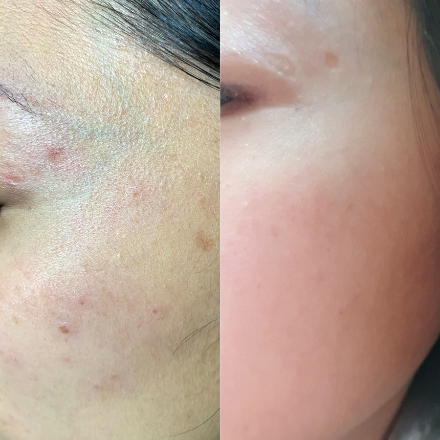 Pico laser resurfacing