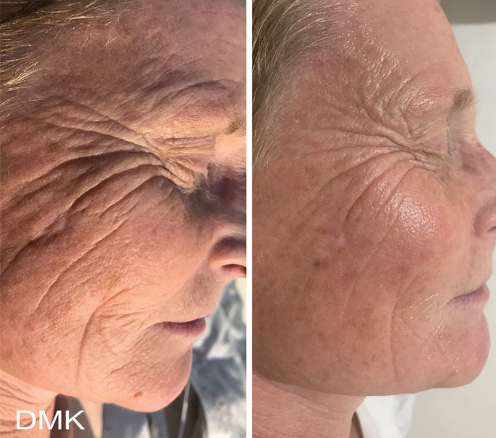 Skin Needling + Enzyme Therapy