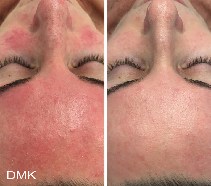 DMK Enzyme Facial - Level 2