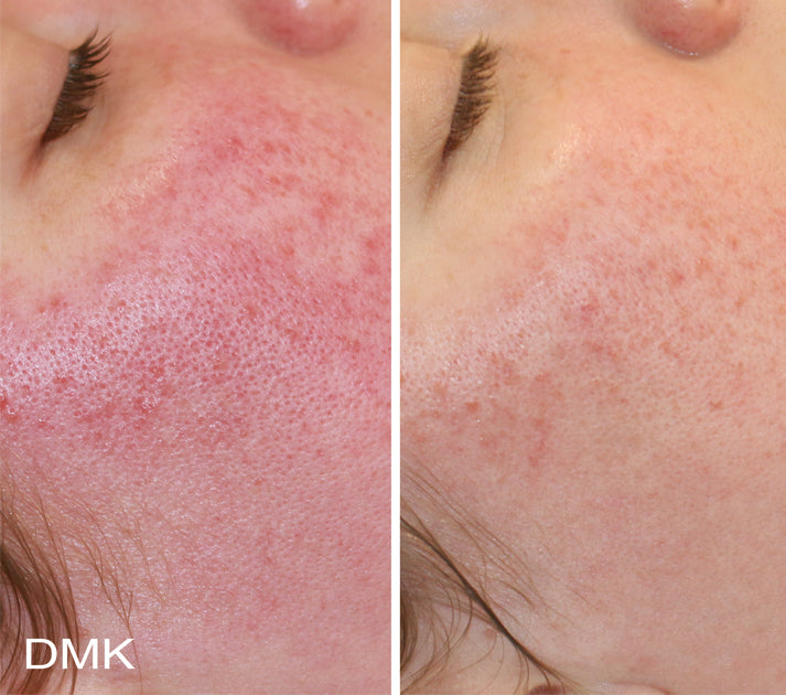 Enzyme Facial - Level 3