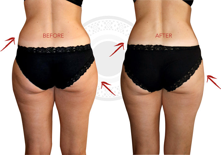 Endermologie