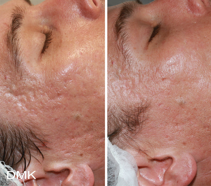 Skin Needling + Enzyme Therapy