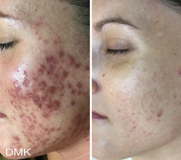 Skin Needling + Enzyme Therapy