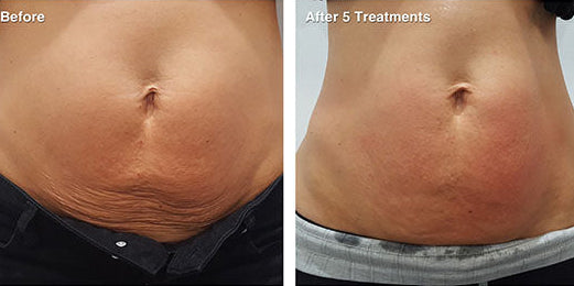 RF Skin Tightening for Body