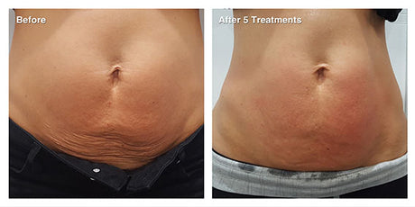 RF Skin Tightening - Body