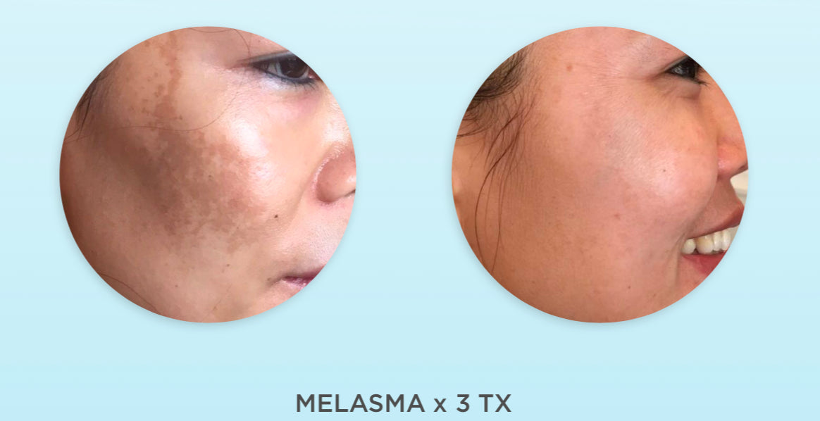Dermapen Skin Needling