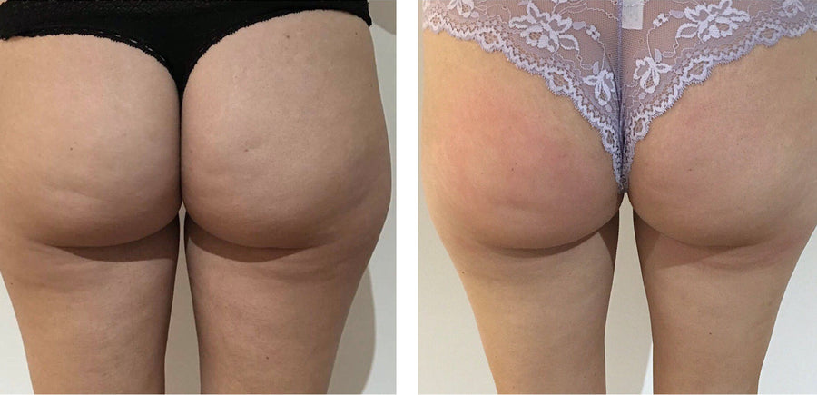 Fat Cavitation