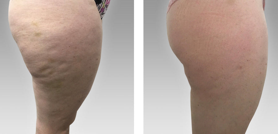 Fat Cavitation