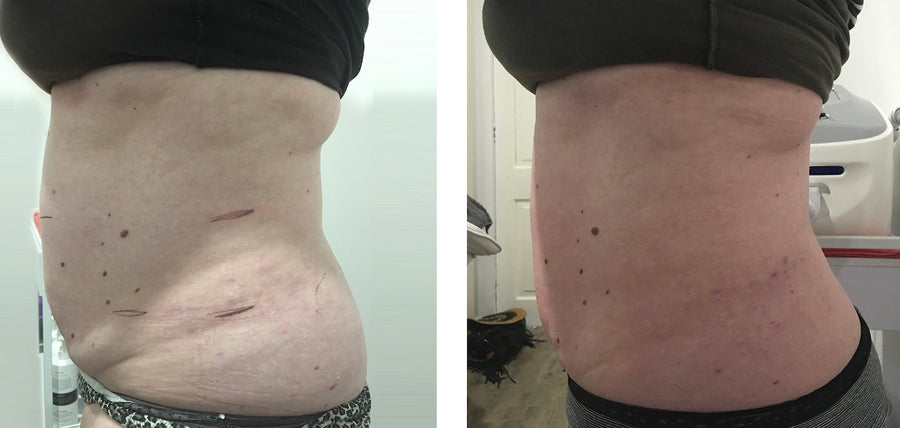 Fat Cavitation