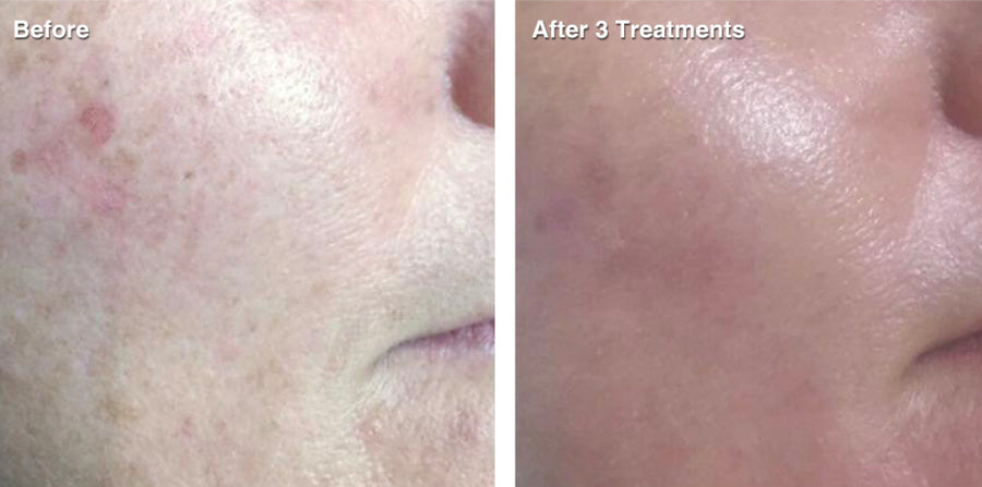 IPL Photo Rejuvenation