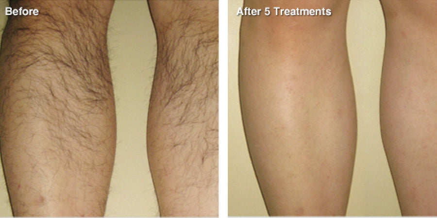 IPL Hair Removal