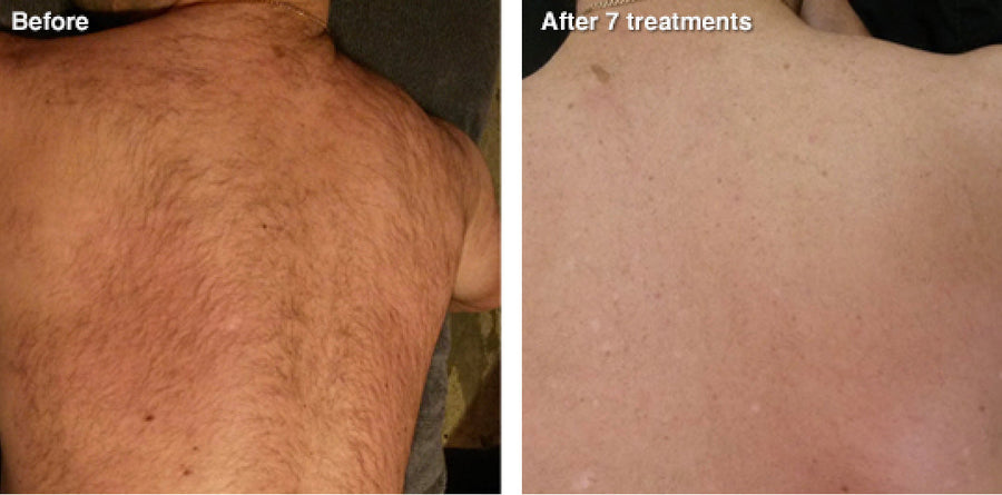 IPL Hair Removal