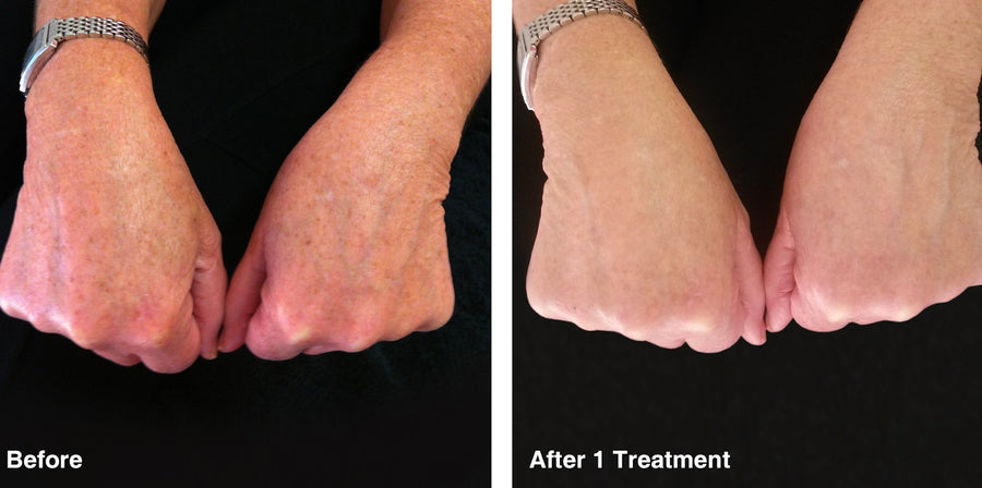 IPL Photo Rejuvenation
