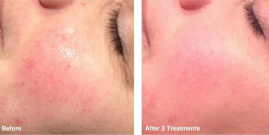 IPL Photo Rejuvenation