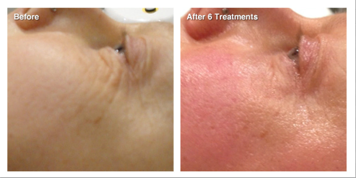 RF Skin Tightening - Face