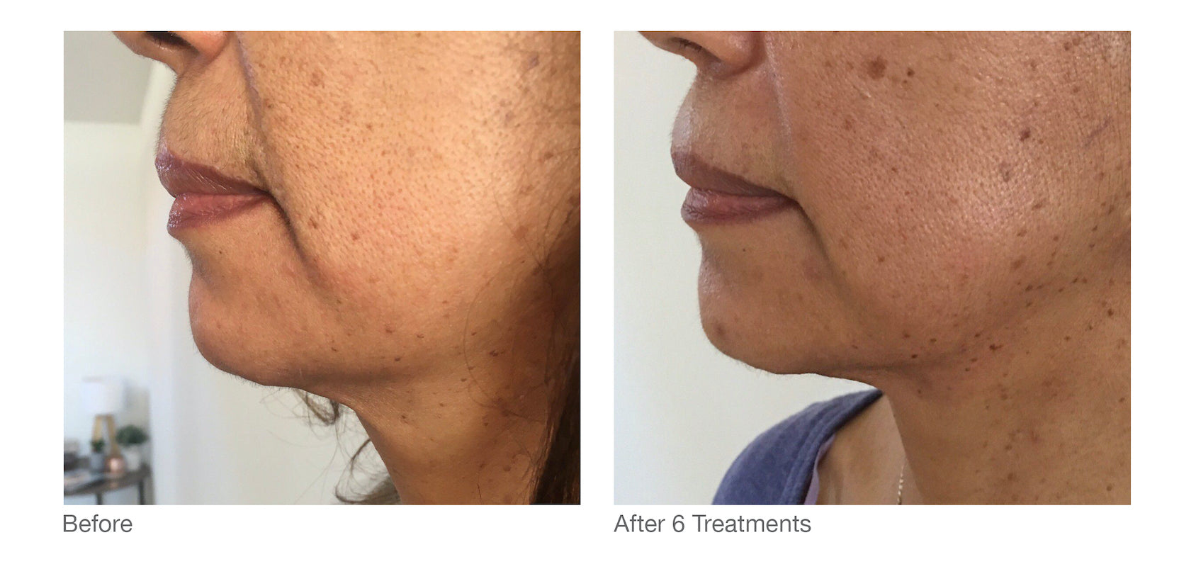 RF Skin Tightening - Face