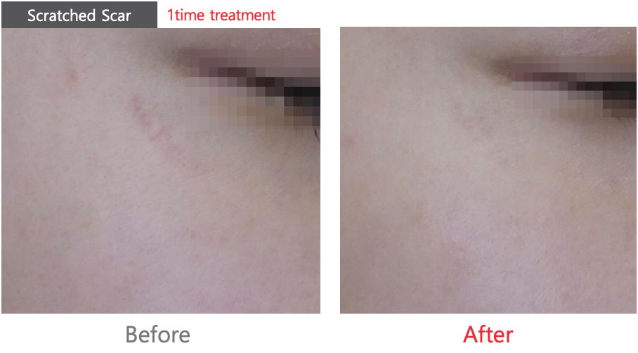 Pico Laser Skin Resurfacing