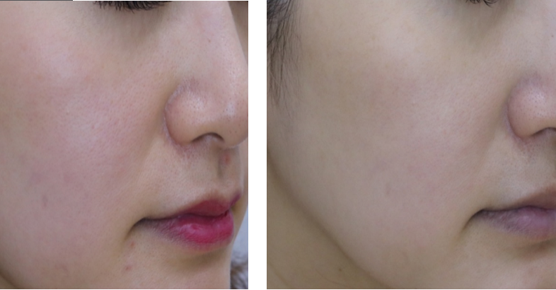 Pico laser resurfacing