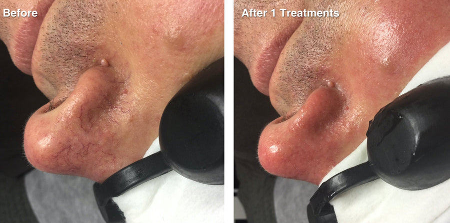 IPL Photo Rejuvenation